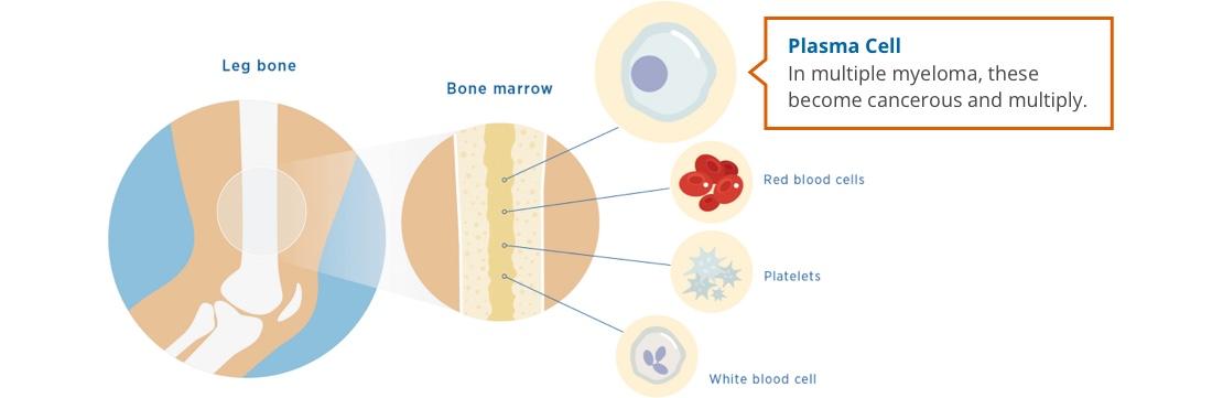 Diagram showing plasma cells within bone marrow. In multiple myeloma, plasma cells become cancerous and multiply.