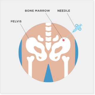 Illustration of a bone marrow biopsy.