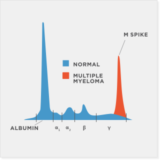 Normal albumin vs an M spike with multiple myeloma.